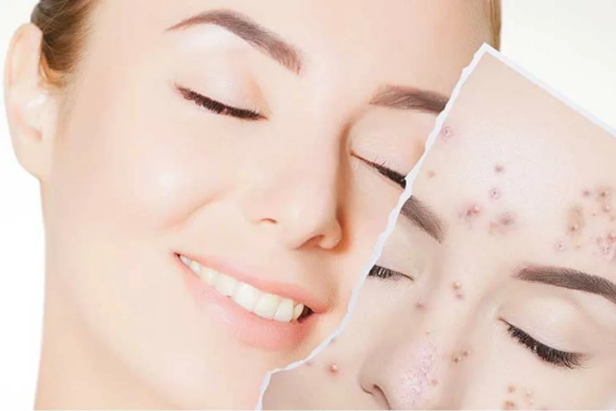 Какой косметикой нельзя пользоваться, если у вас акне